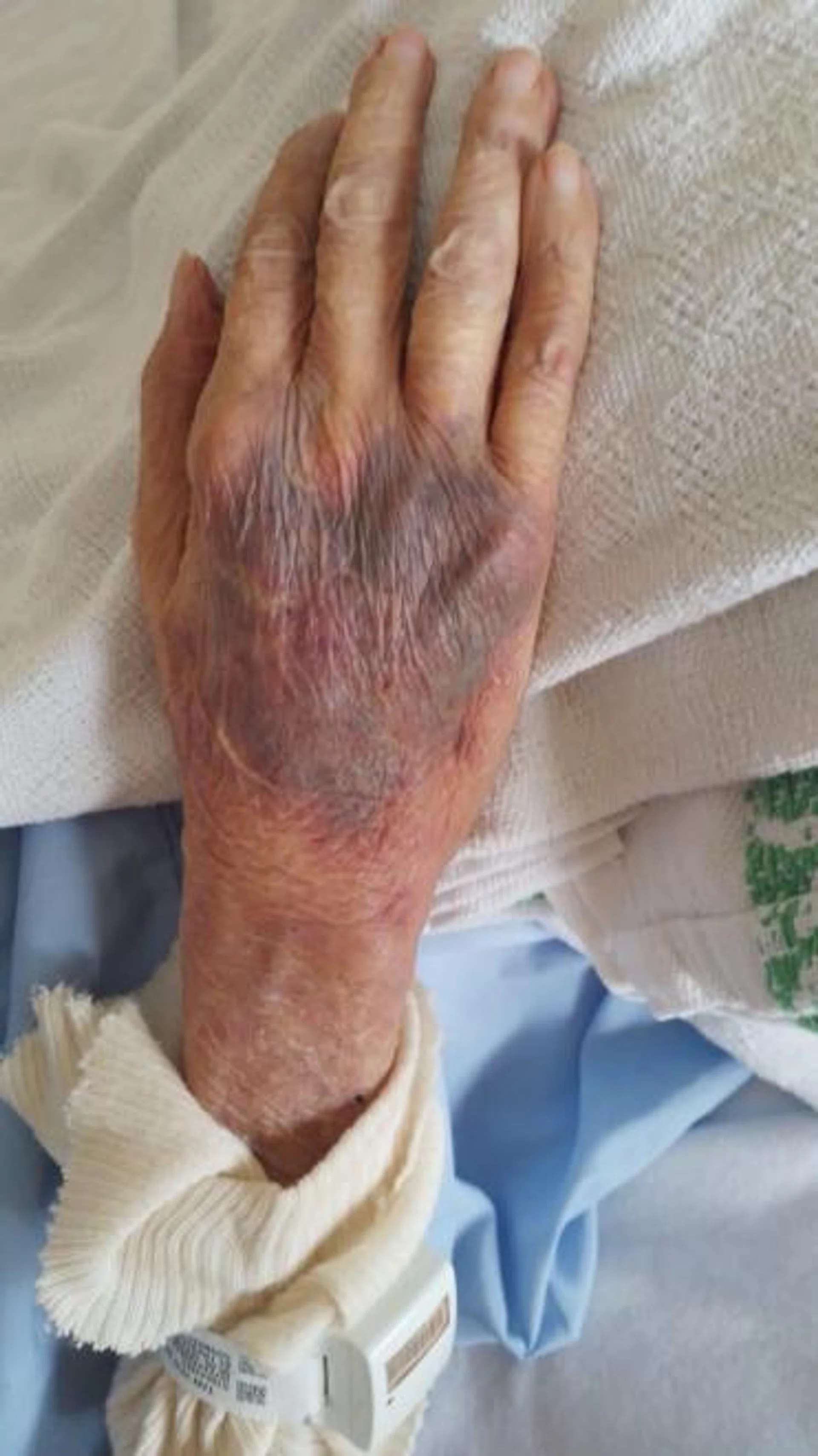 A photo of the bruising on Ms Tan's father.