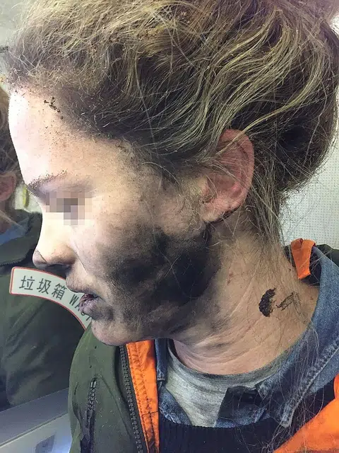 Woman burnt after her headphones explode on flight