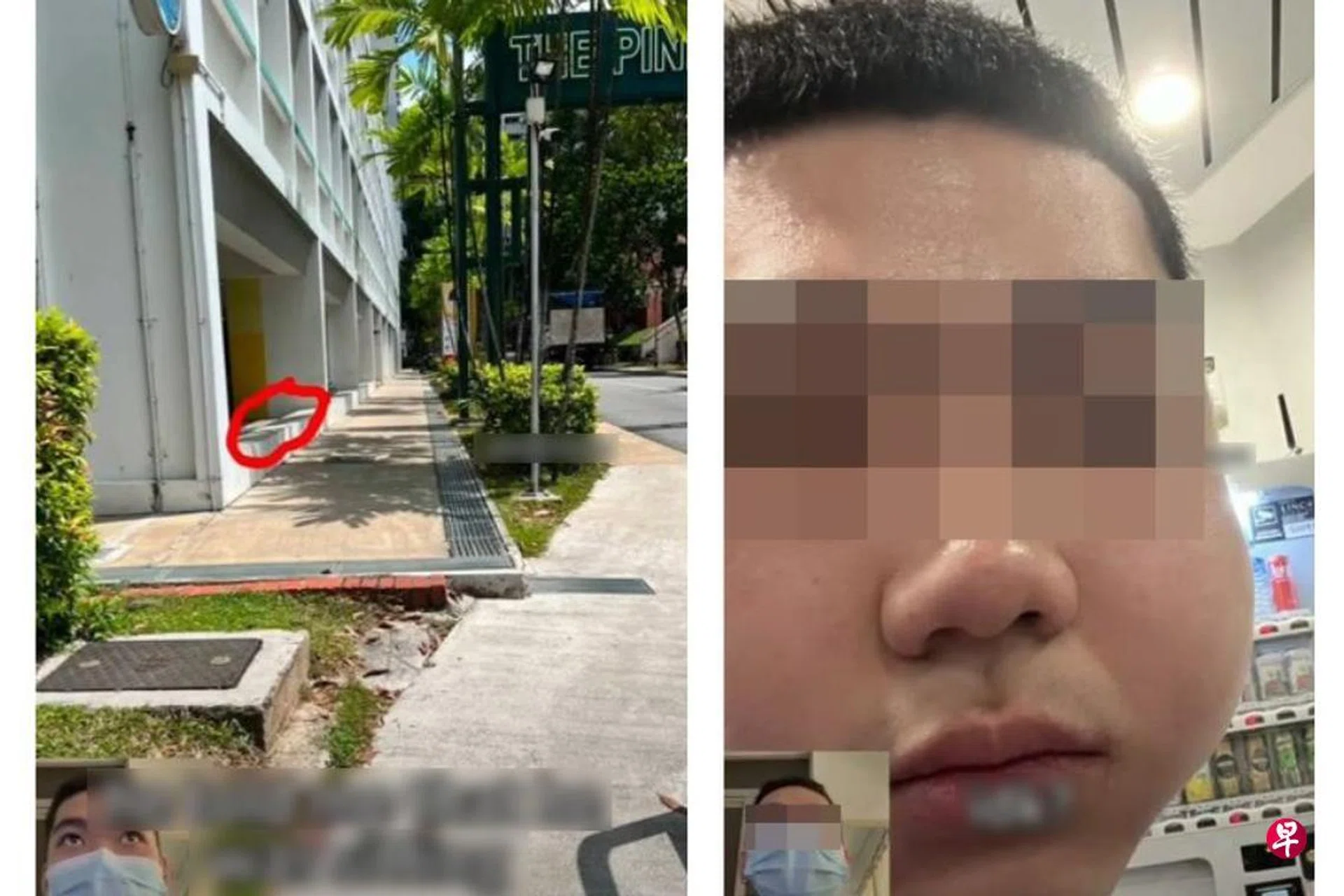 The victim first met the man outside an HDB carpark (left), before being assaulted. His left cheek was visibly swollen from the punch (right).