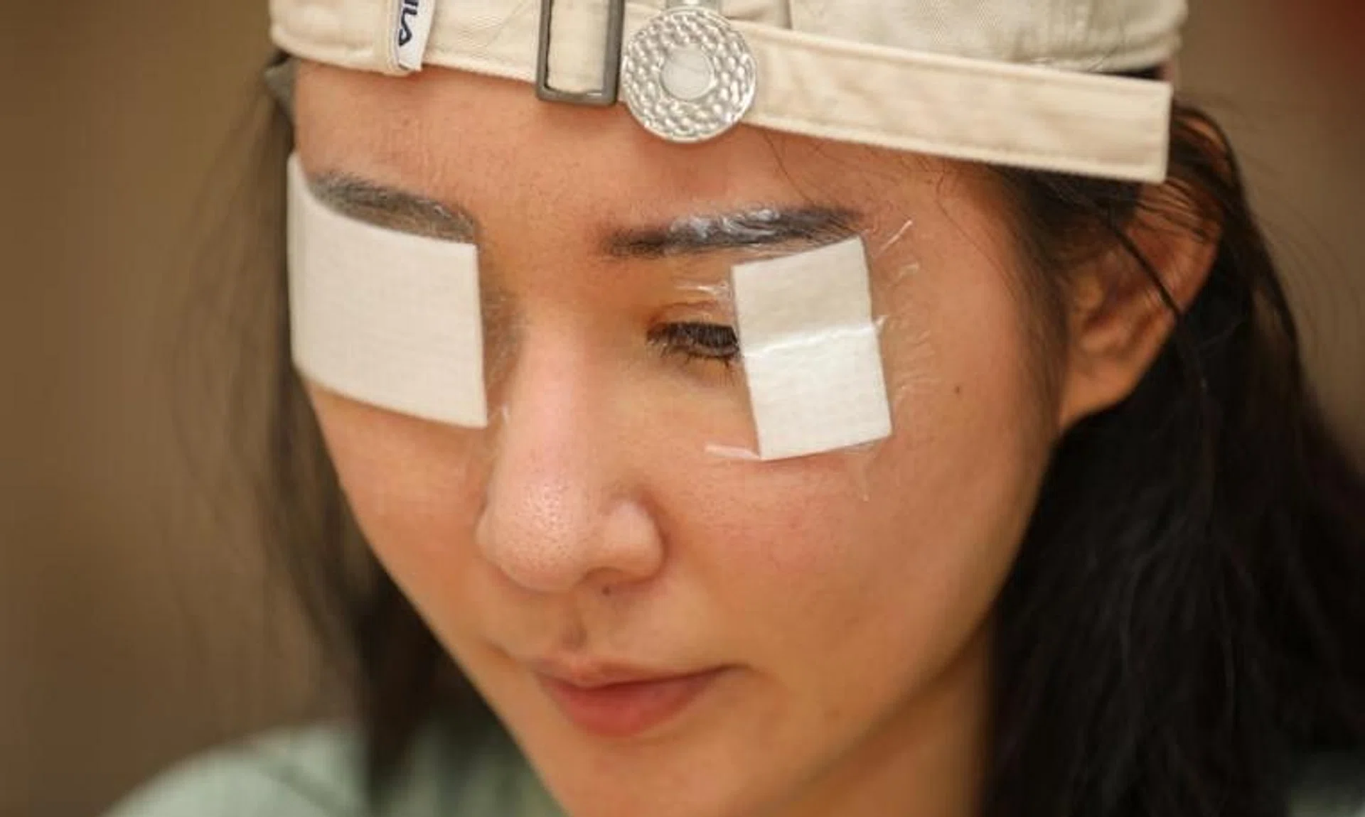 Aden, 32, suffered formaldehyde-induced conjunctivitis and wound infection of the eye after renovating her apartment. 