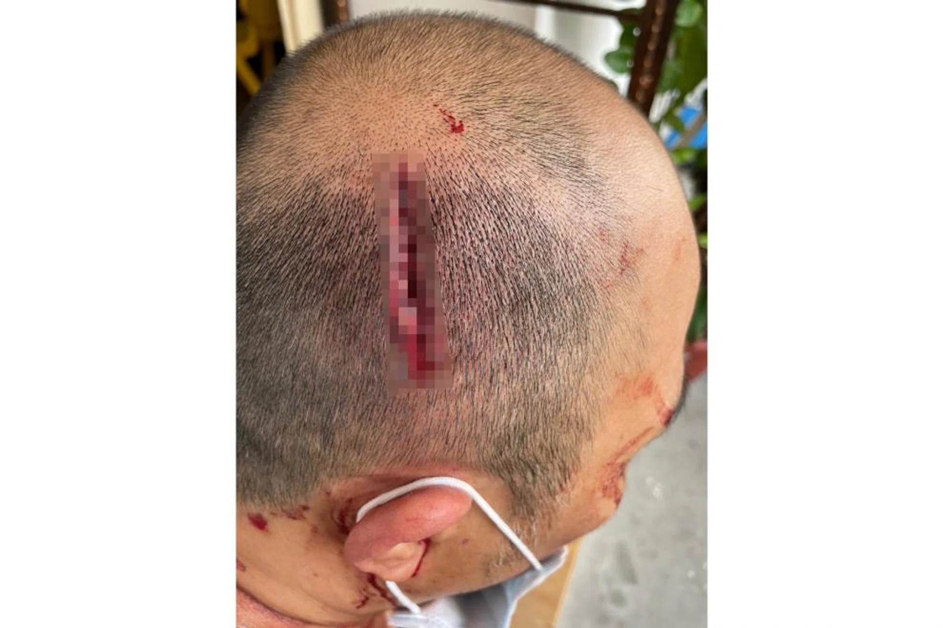 Mr Toh needed five stitches for the 4cm wound on his head. 