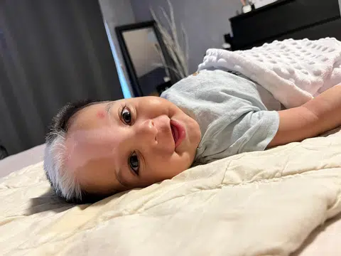 Toddler Mohamed Zain Azharuddin was born with a white forelock and patchy skin. He inherited his rare genetic disorder from his mother.