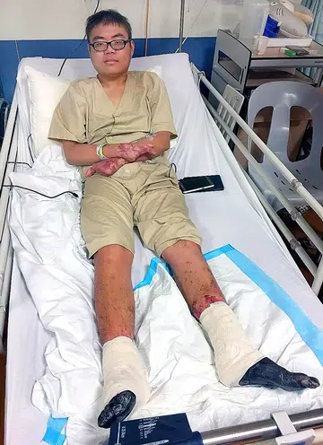 He had to amputate his legs to walk again