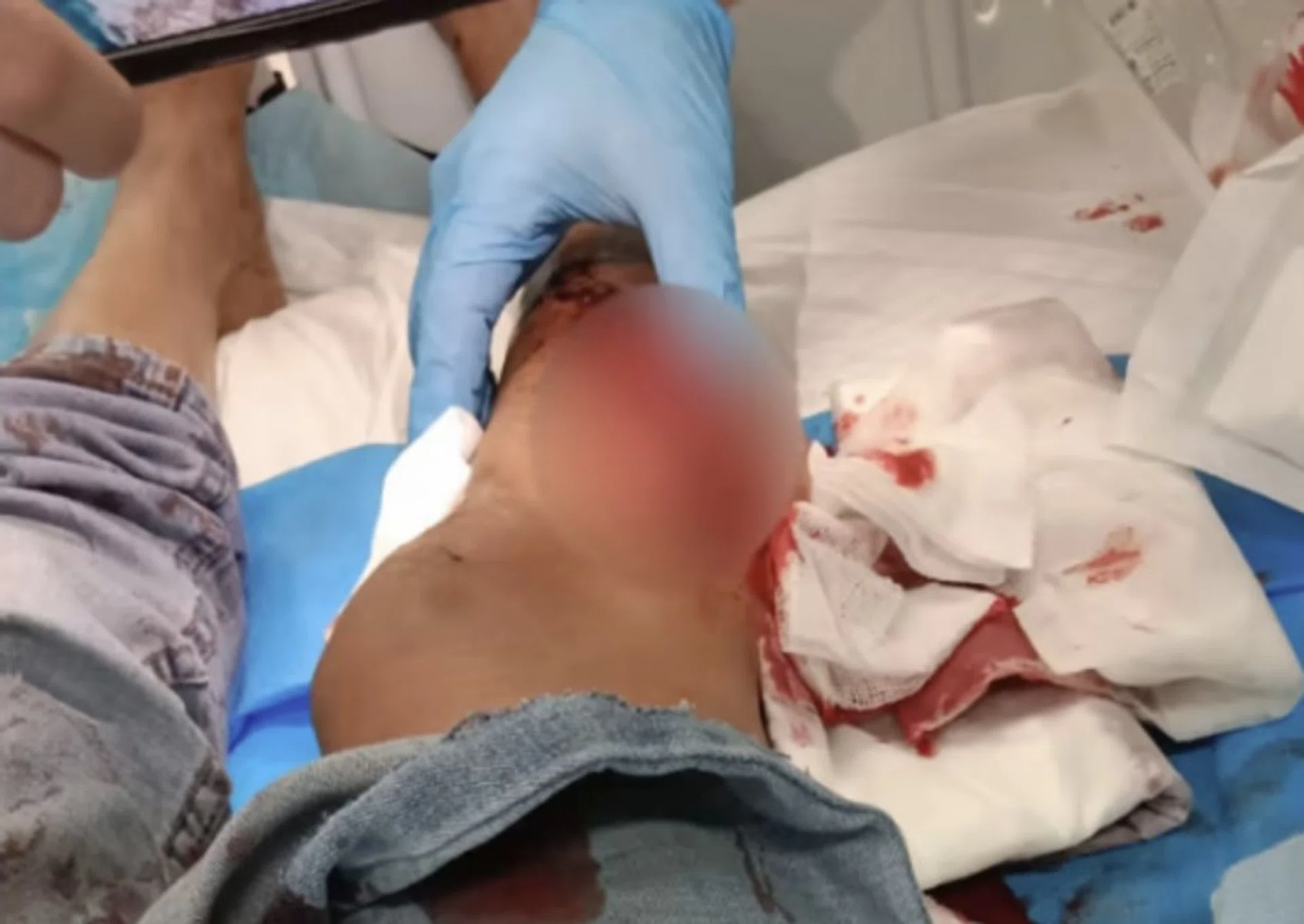 The victim has since undergone three rounds of surgery for her injuries.  
