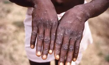 Why monkeypox may soon get a new name