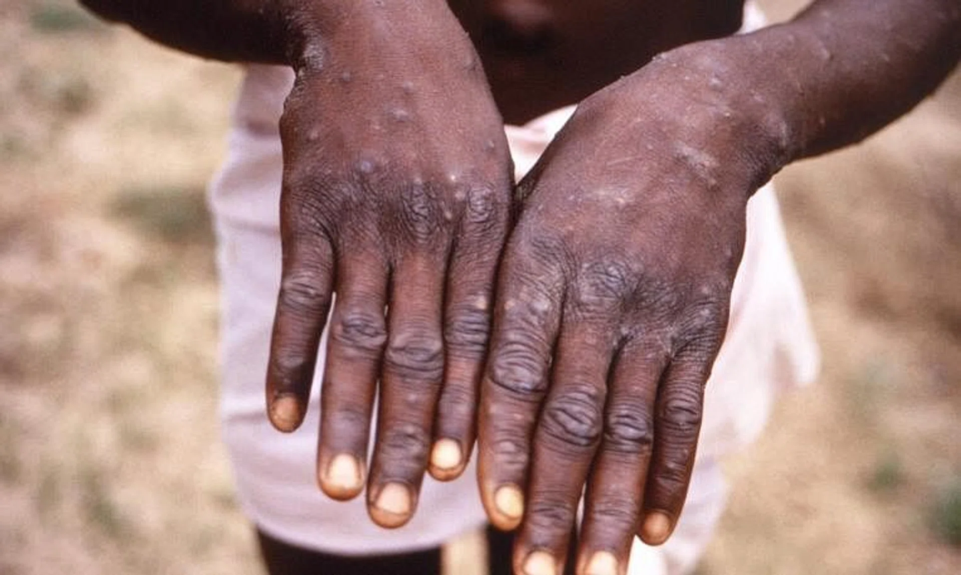 Monkeypox's clades have been particularly controversial because they are named after African regions.