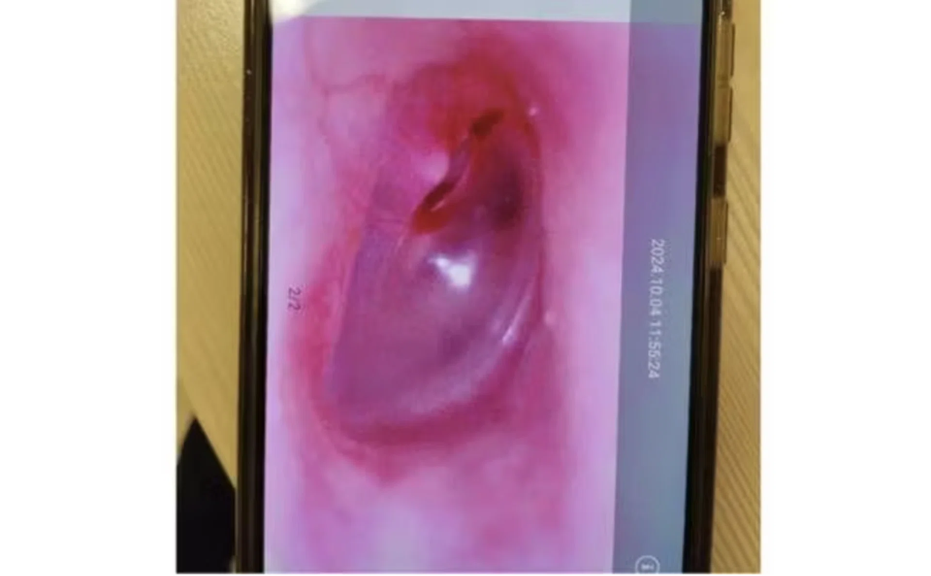 An image of the girl's ruptured eardrum.