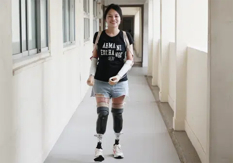 Woman who lost limbs to sepsis gets 'new' legs and hands