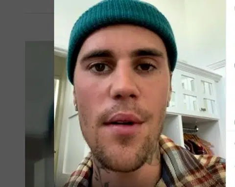 Part of Justin Bieber's face is paralysed