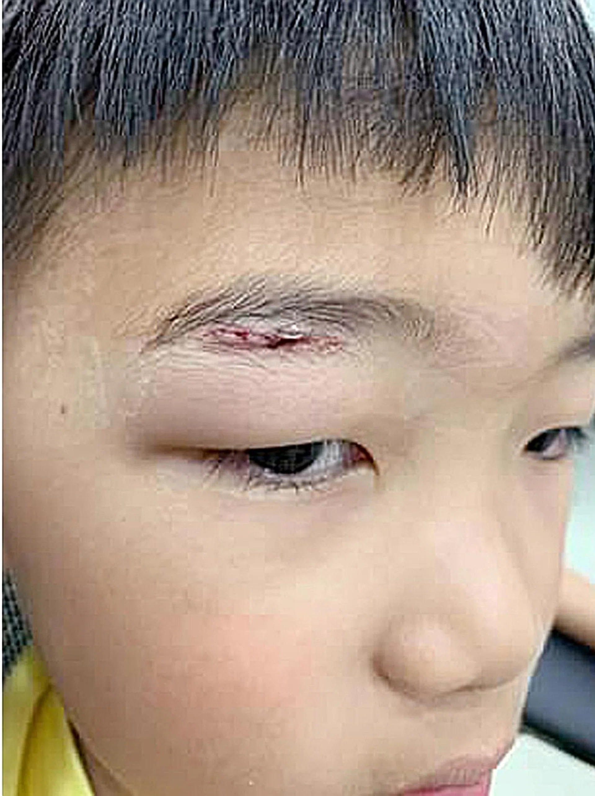 The boy suffered a cut above his right eye which did not require stitches, and his glasses were cracked. 