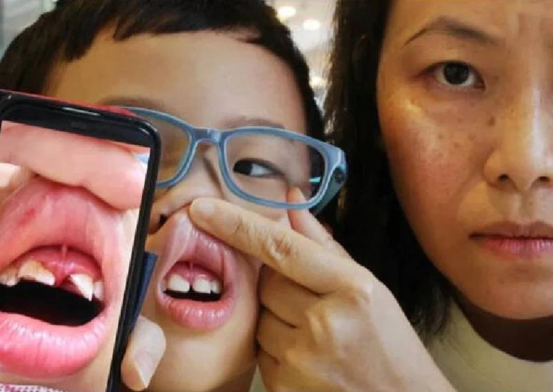 Wu had to fork out around $1,000 in medical fees, and her son must now avoid certain foods so as to not put pressure on the broken teeth.