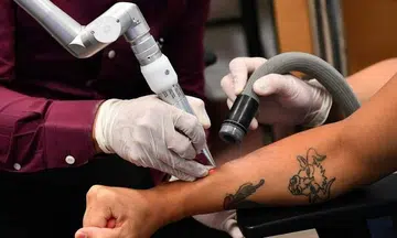 Tattoo removals subsidised for young people finding work or trying to stay in school