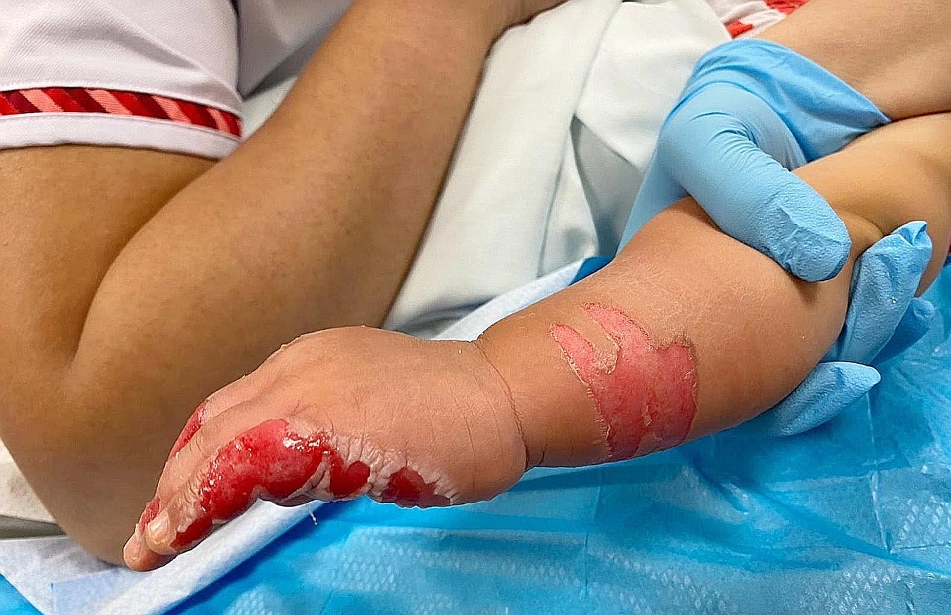 (Above) The baby has second-degree burns.