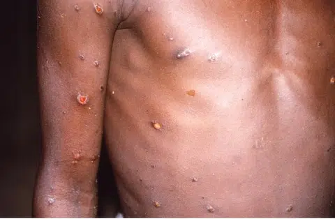 Monkeypox kills up to 10% of those infected, smallpox vaccine may stop it