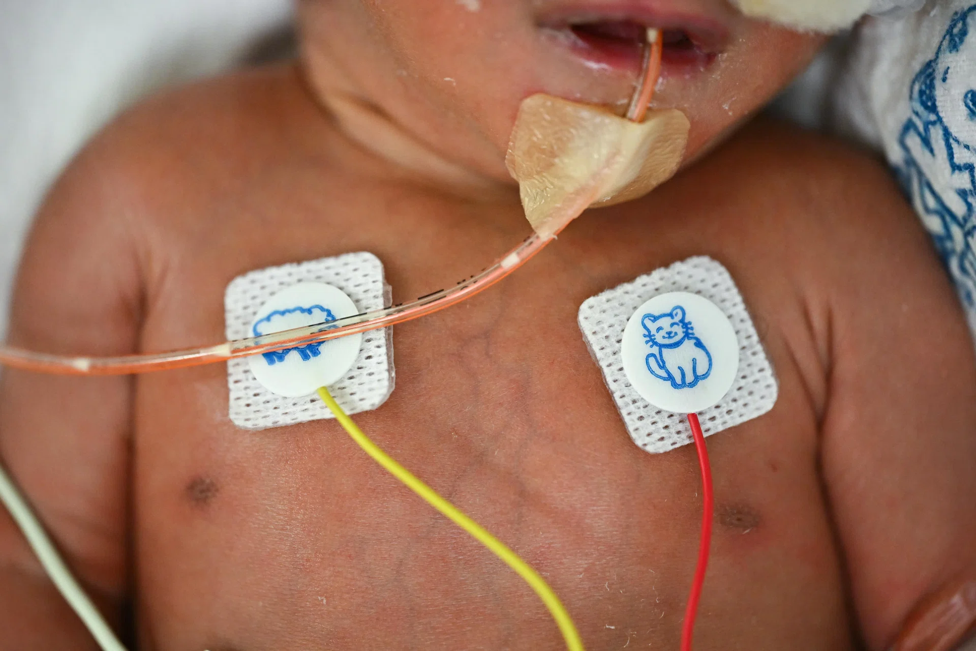 The women have to deliver by the 35th week of pregnancy at the latest, which means the babies are born premature.