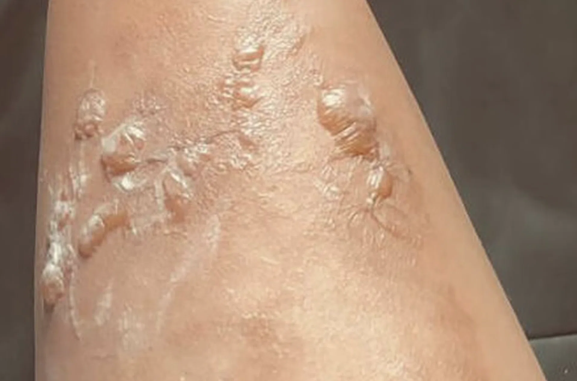 The woman had blisters from the burn.