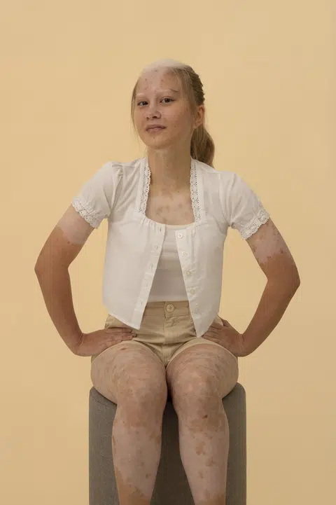 Despite her condition, Stefanie Dowideit embraces life to the full, participating in outdoor activities like swimming, skiing and hiking, all while wearing a hat to protect her from the sun.