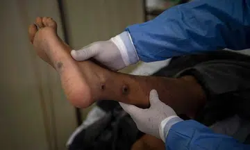 'Crying all the time': Monkeypox patients reveal psychological scars
