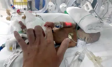 Parents of twins with rare condition: We can't hold our babies