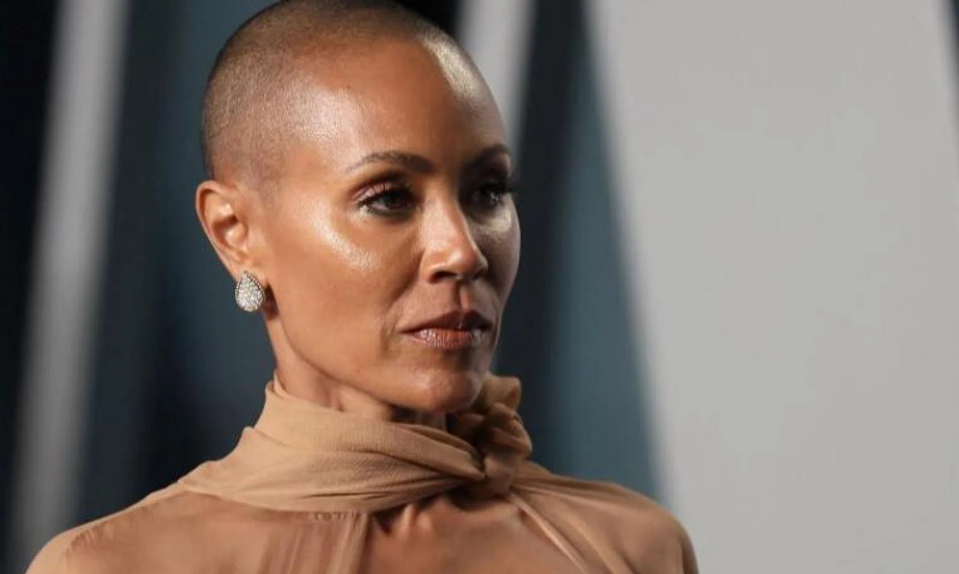 Jada Pinkett Smith, an actor and talk show host, has a medical condition that causes hair loss.