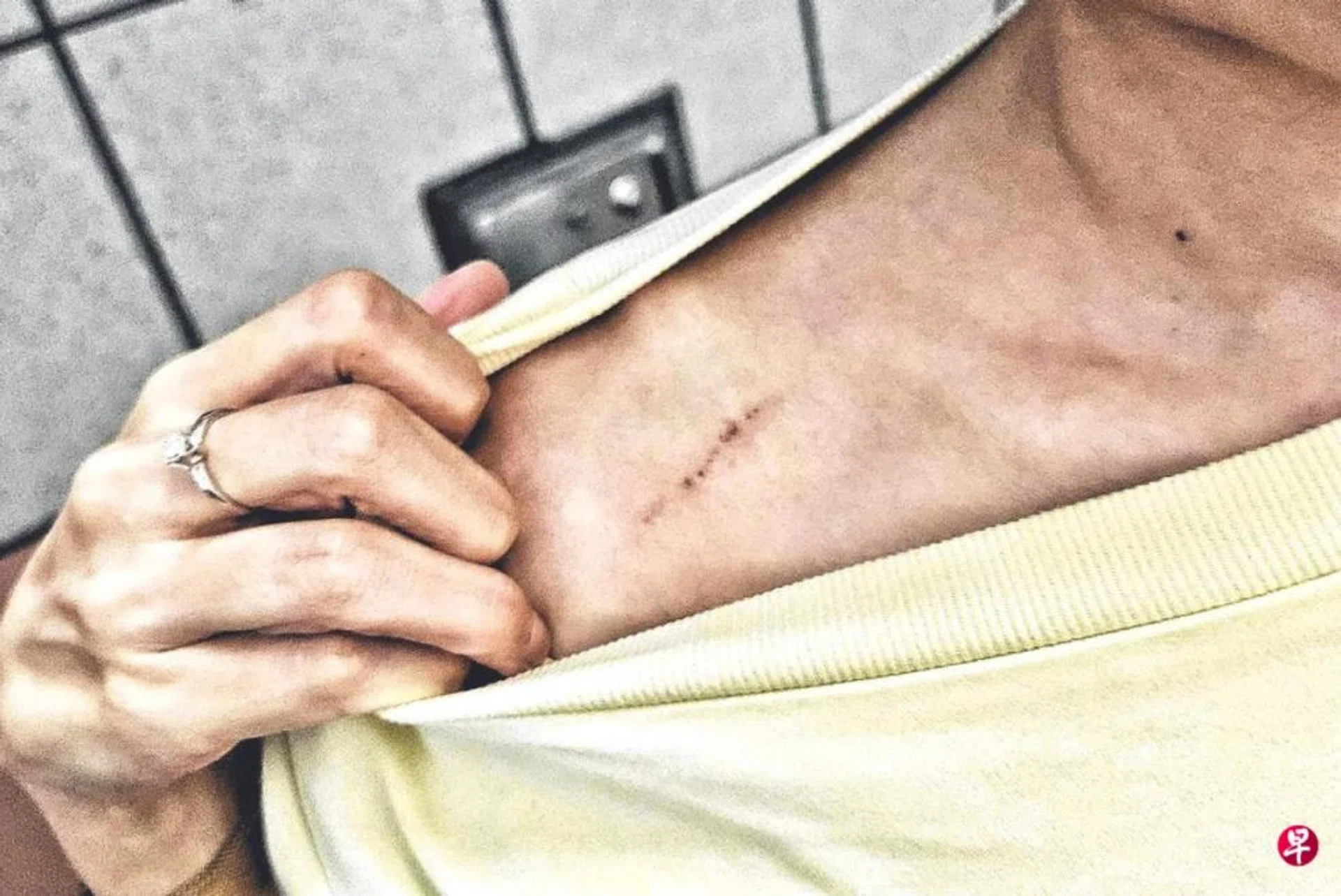 Ms Chen suffered multiple scratches during the fight.