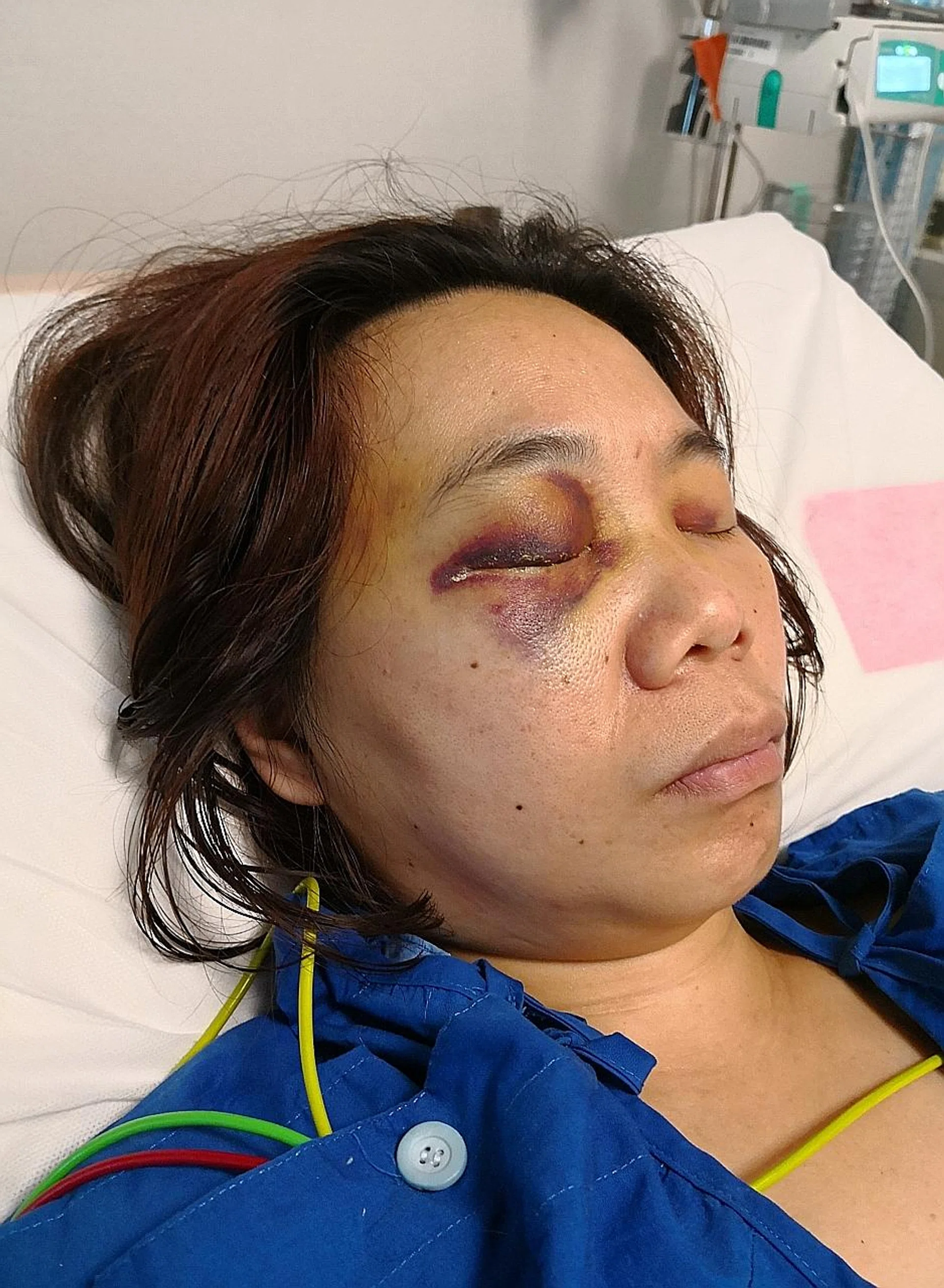 Ms Goh Lay Yong, a victim of an e-scooter accident in Bedok.