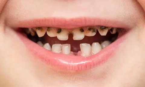 About 1 in 2 children here has tooth decay by kindergarten age