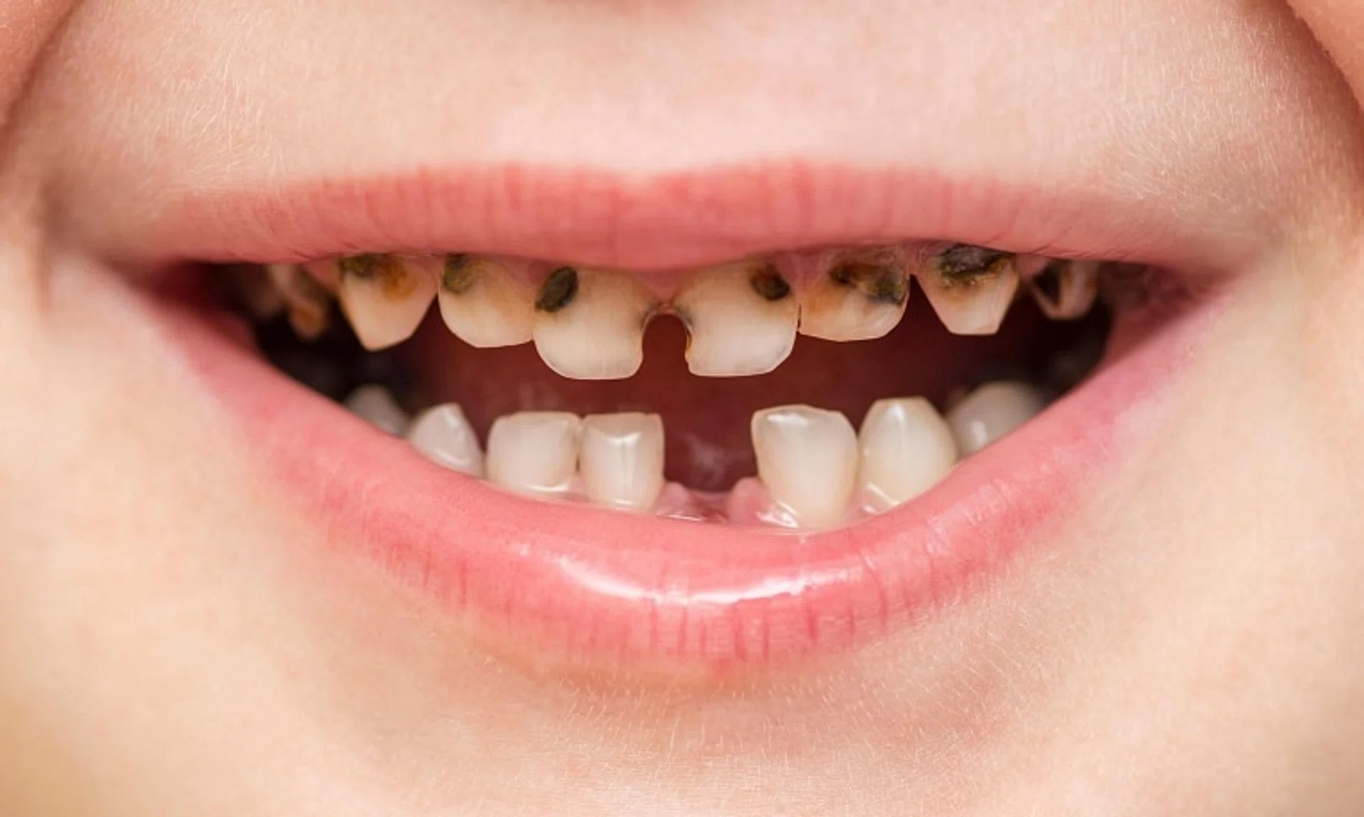 Tooth decay in very young children is especially aggressive, and when left untreated, can rapidly destroy the entire tooth and lead to infections.