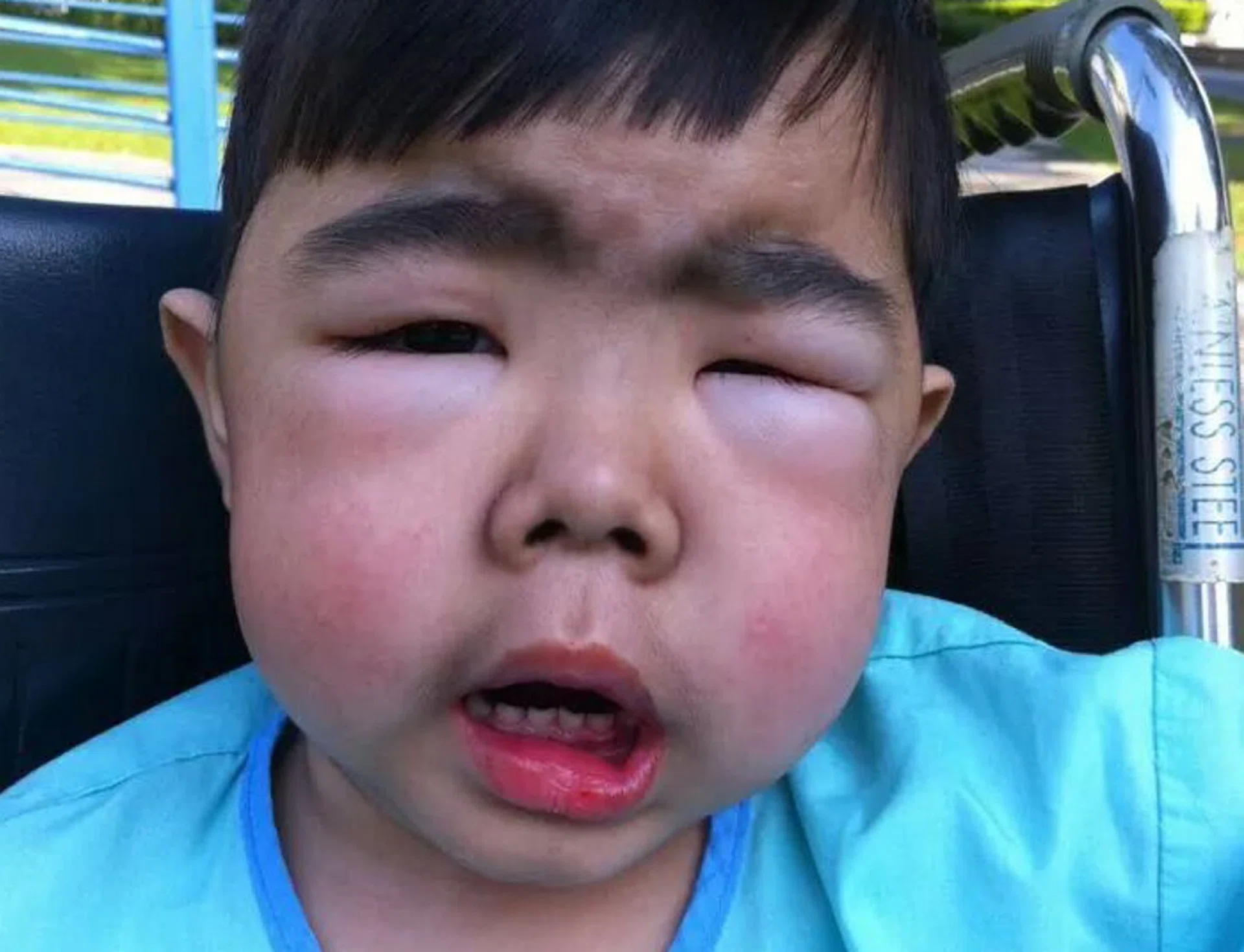 ROAD TO RECOVERY: When Hazrie Alisman Norahman was a toddler, he was so swollen from water retention that his eyes narrowed to slits and it hurt him to be picked up.