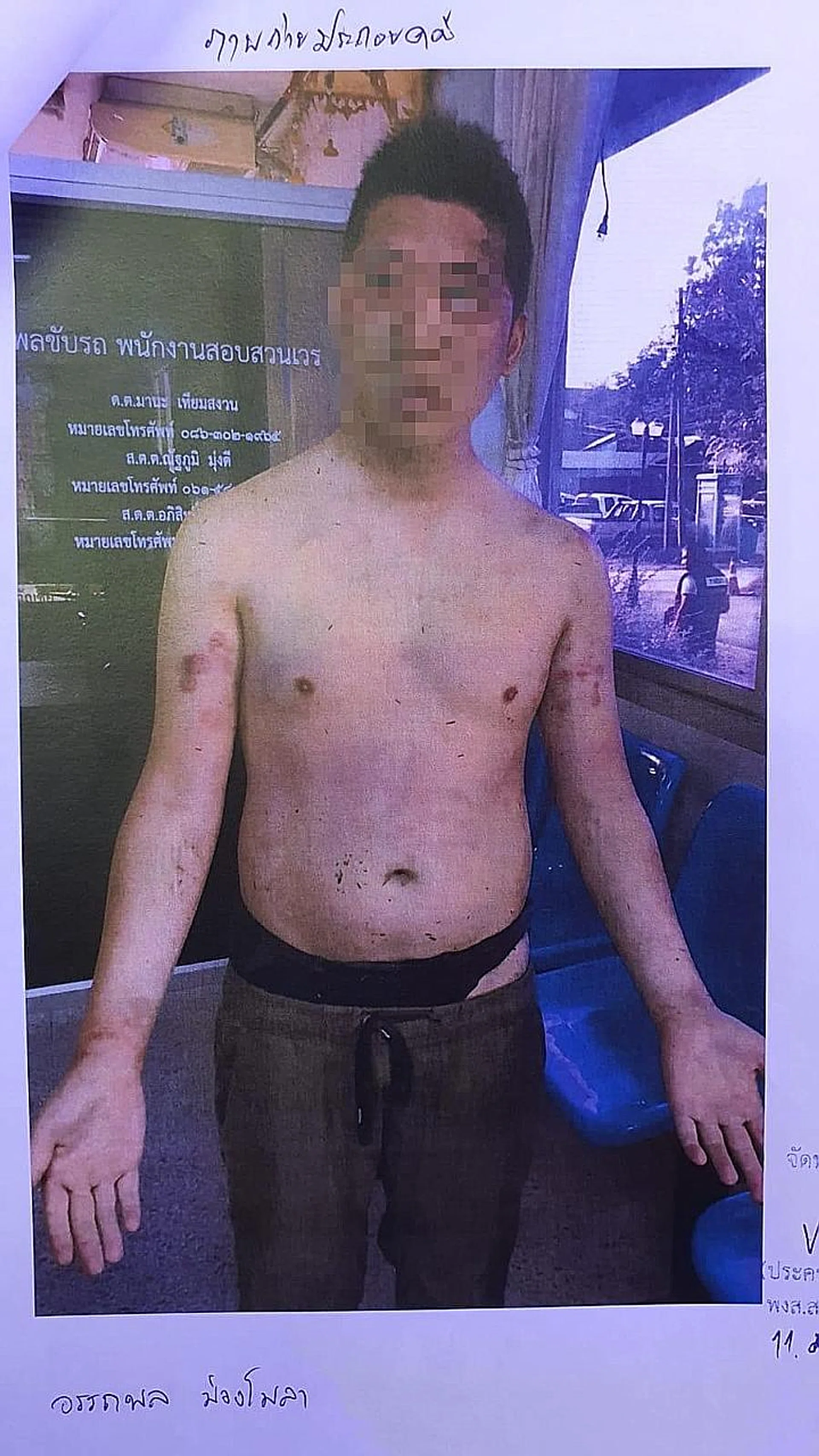 After he was allegedly beaten by a group of masked men in Bangkok last week.