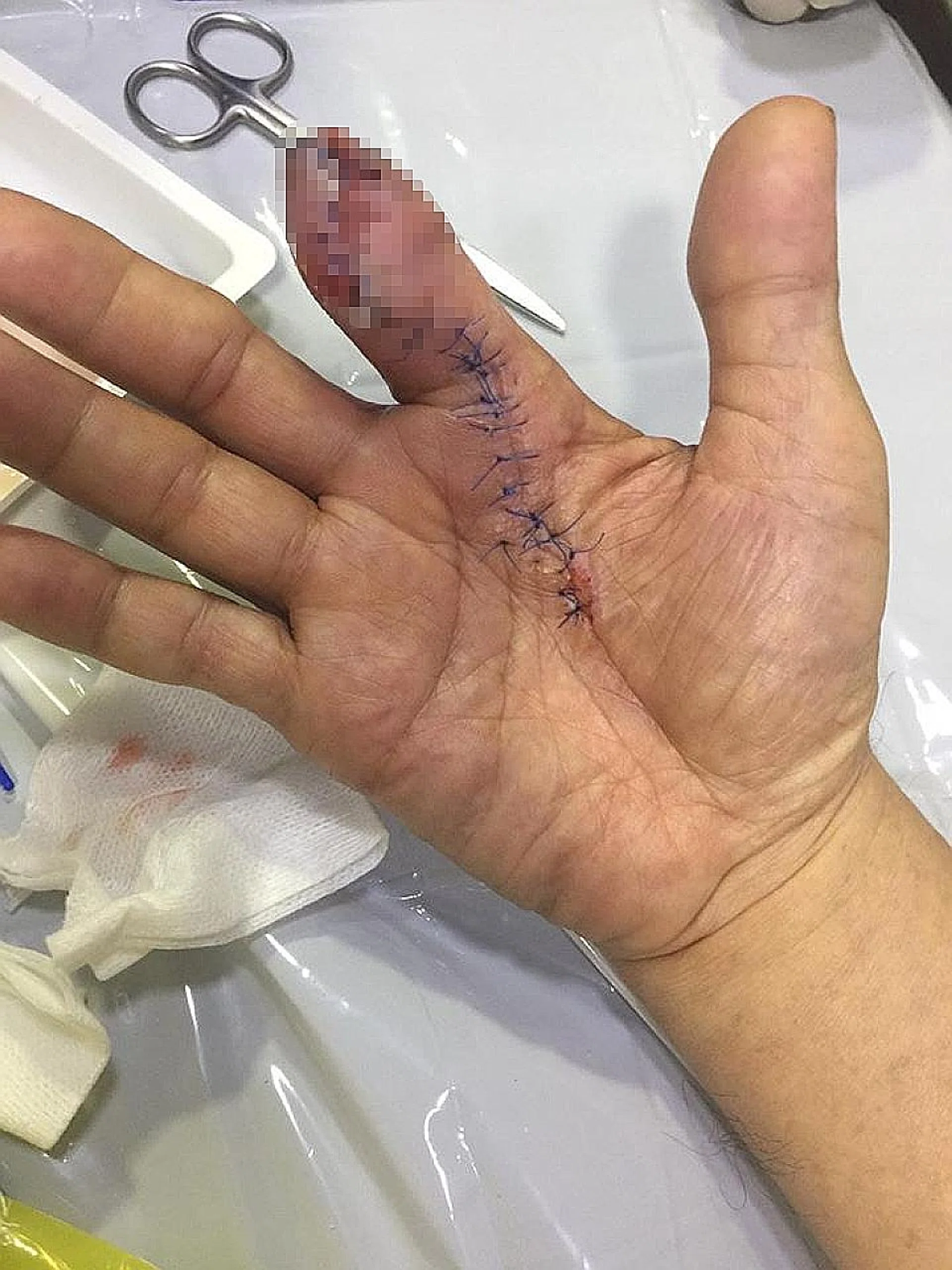 The man underwent surgery and was in hospital for seven days, including two days in the intensive care unit.  