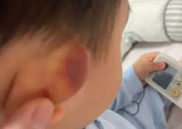 Parents worried after toddler returns home from Yishun pre-school with bruise on ear