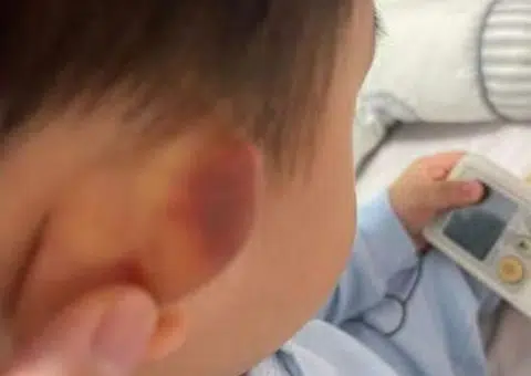 Parents worried after toddler returns home from Yishun pre-school with bruise on ear