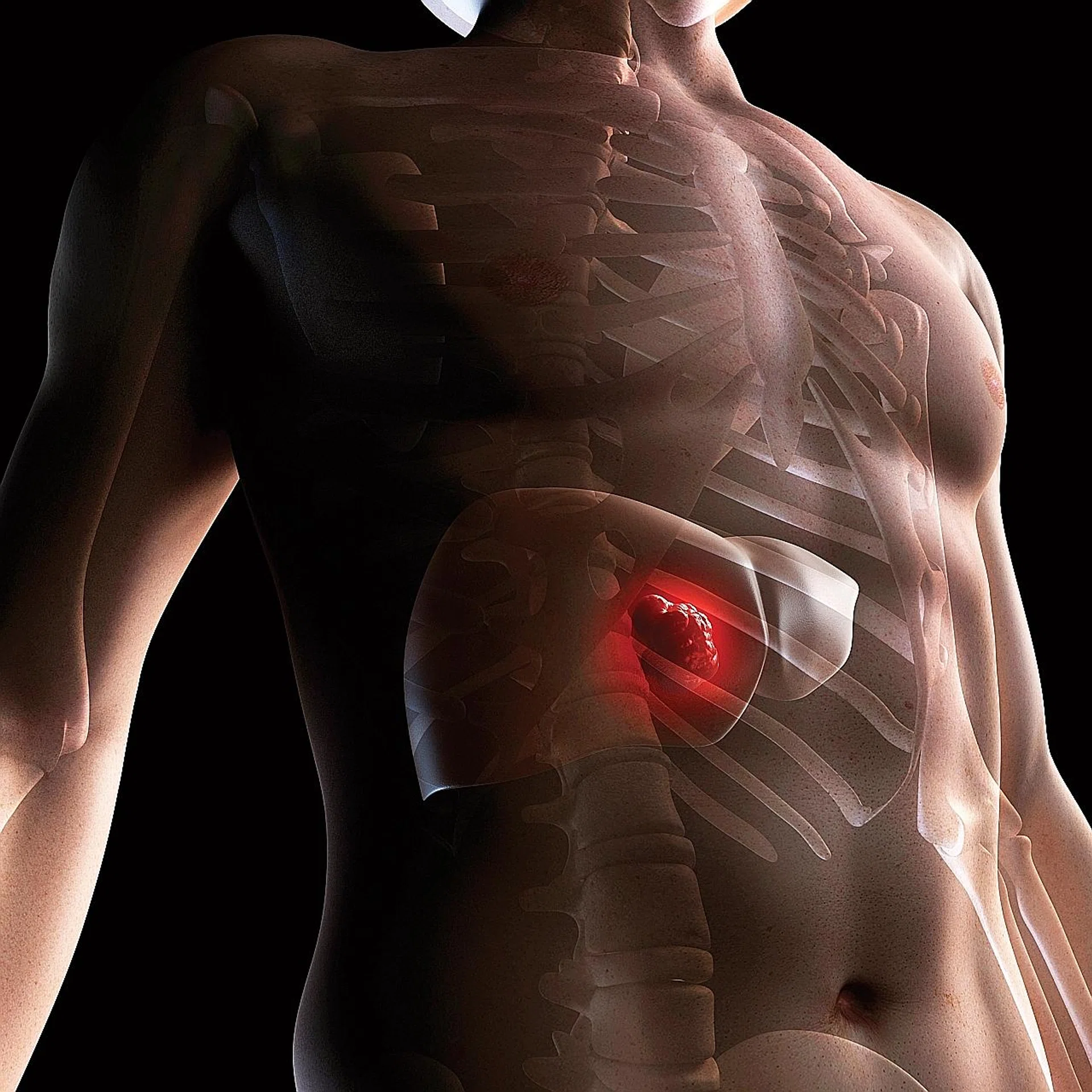 HCC is the most common type of primary liver cancer.