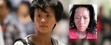 Eczema almost killed her