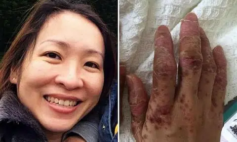 Mother loses hair, fingernails in HFMD horror