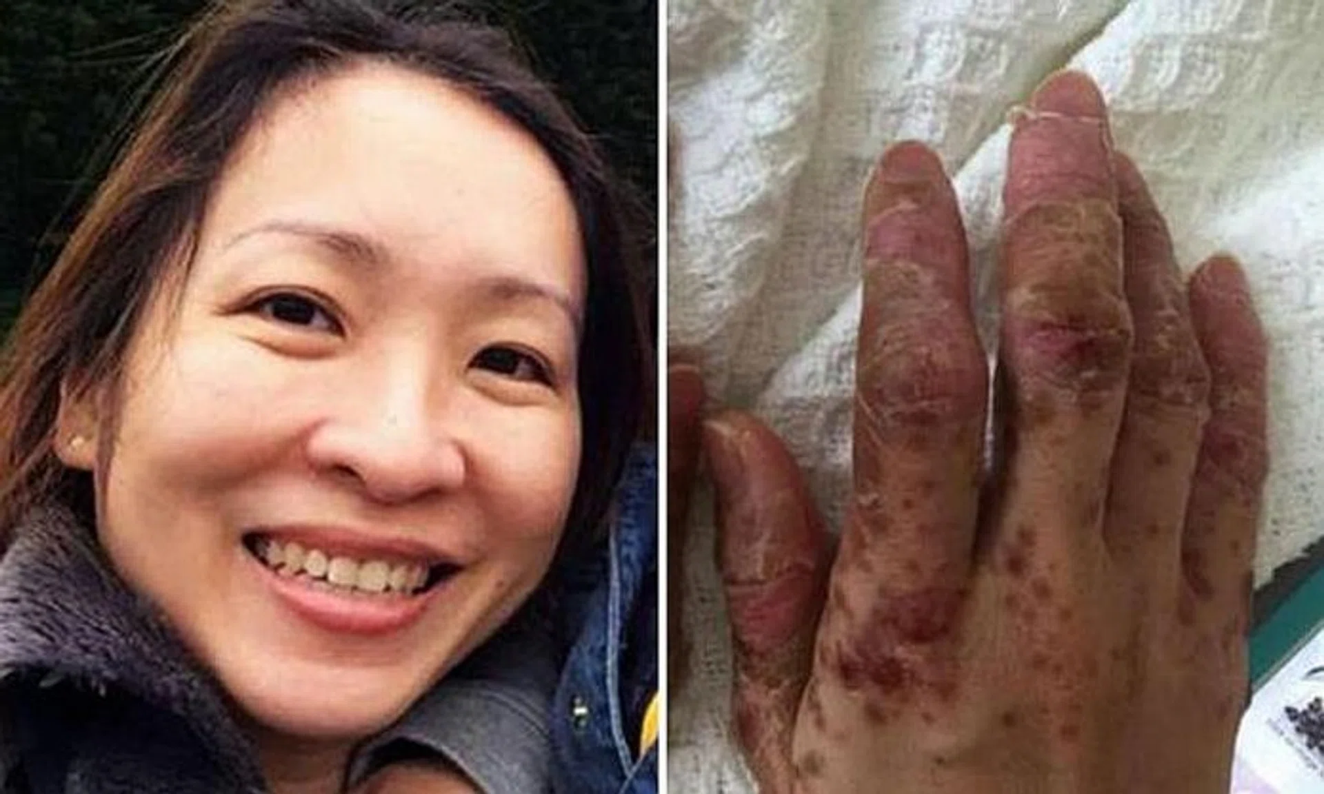 AGONY: By Day 8, the blisters on Ms Yeo's hands had ruptured, so the skin peeled.