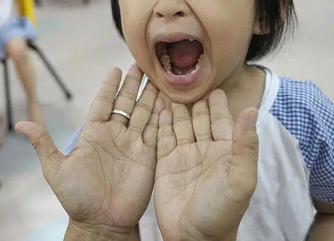 Hand, foot and mouth disease: What you need to know
