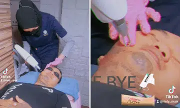 Ex-convict undergoes painful tattoo removal to gain confidence