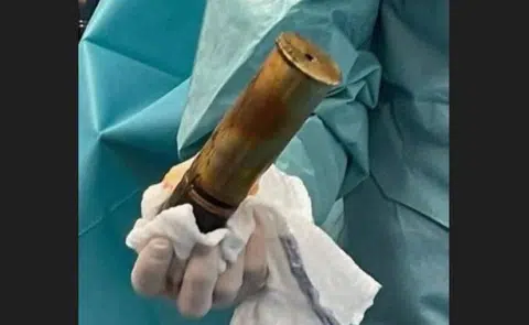 Emergency case at French hospital - man with bomb in bum