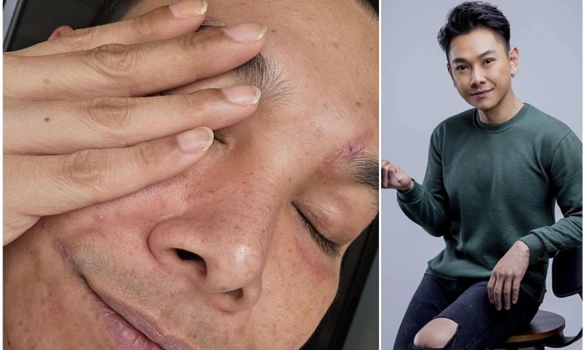 Actor Ryan Lian shared close-ups of his three scars: one by the side of his lip, one on his chin and another around his left eyebrow. 