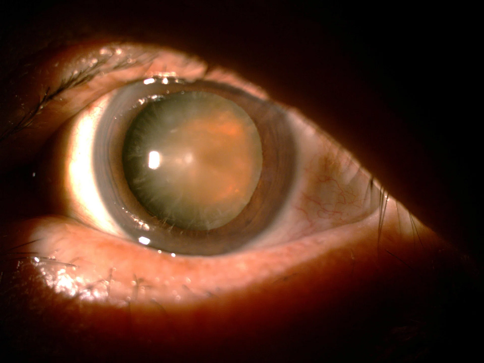 DARK:  A cataract is a clouding of the lens in the eye leading to a decrease in vision. 