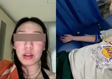Singaporean in Batam rushed to hospital after face "balloons" from sandfly bites