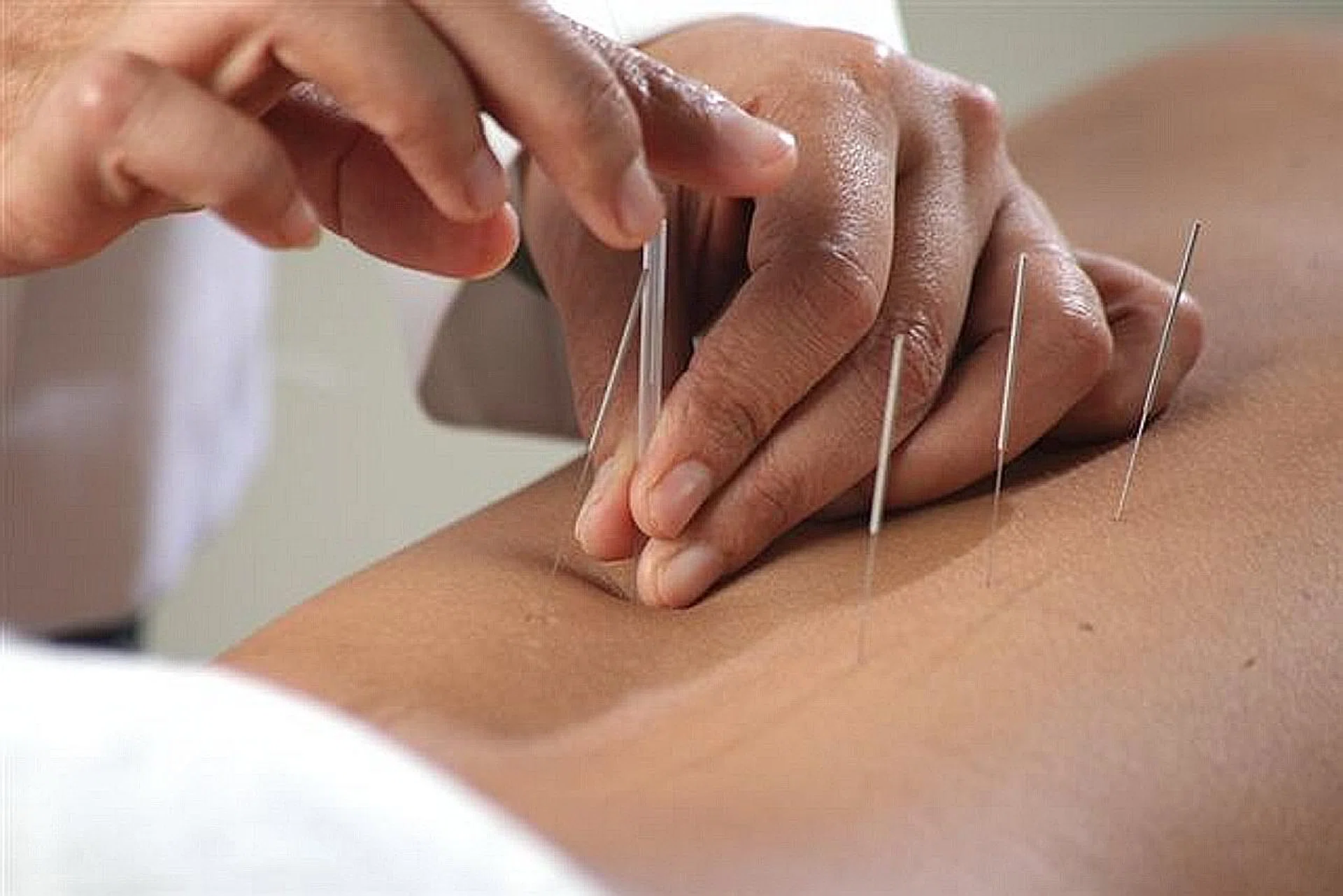 Madam Lim Li Chin said acupuncture helps her sleep better when she is struggling with itch. 