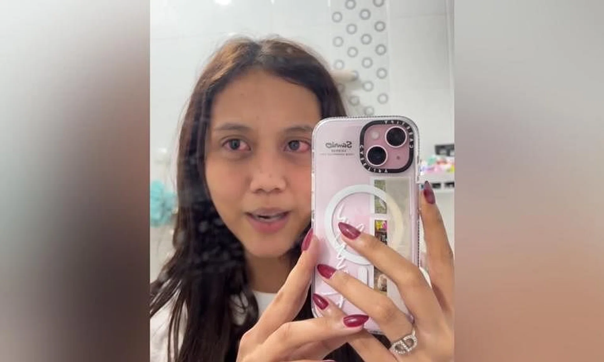 Ms Azula said she felt a stinging sensation in both eyes after a few hours of wearing the contact lenses.