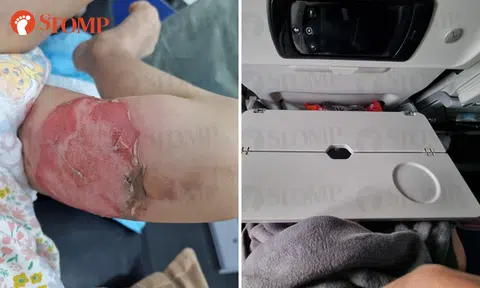 4-year-old girl scalded by boiling hot tea on flight, mum warns about poor tray design