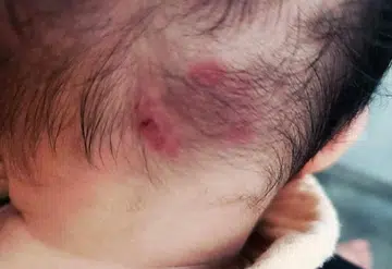 Twin girls bitten at daycare