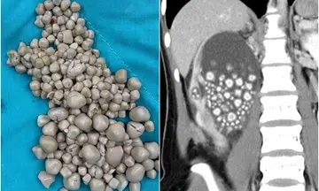 Taiwan hospital removes over 300 kidney stones from woman who prefers bubble tea to plain water