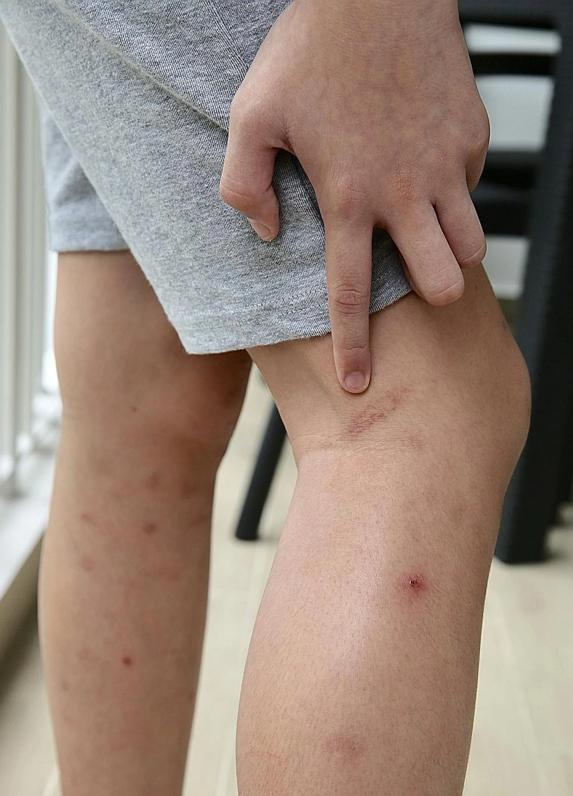 Mrs Claire Chee said her son has one cane mark on the back of his leg, two marks on his left arm and three on his right arm. 