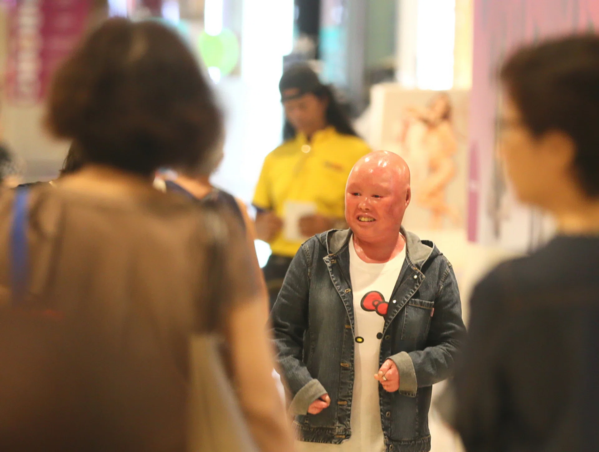 Ms Ng Poh Peng  was born with ichthyosis, a rare skin condition that causes her skin to peel excessively.